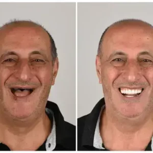 🦷 Custom-Fit Functional Dentures 😁 Smile with Confidence - Image 2