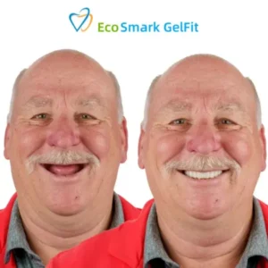 GelFit Dentures - Image 2