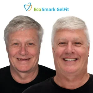 GelFit Dentures - Image 4