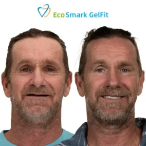 GelFit Dentures - Image 7