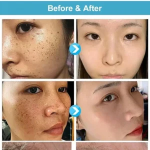 Concentrated potent skin tag removal cream - Image 3