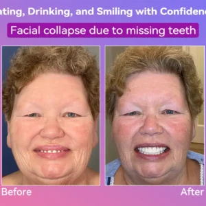 Latest Premium Comfort Dentures - Image 5