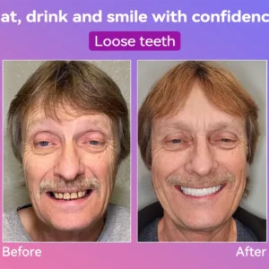 Latest Premium Comfort Dentures - Image 3