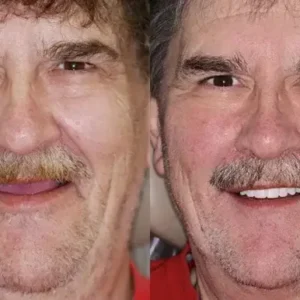 Advanced Customized Full Denture Set - Image 12