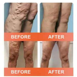 Vein Ease Microneedle Care Patch - Image 3