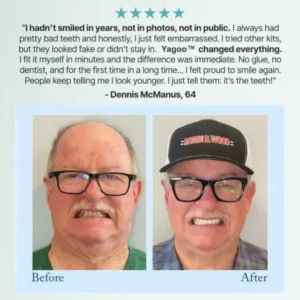 🦷Advanced Customized Full Denture Set🦷 (🔥10,000+ Sold In Last 30 Day) - Image 3