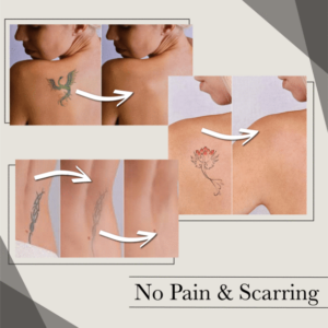 Natural Fading Tattoo Removal Cream - Image 6