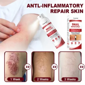 Feariad Snail Repair Spray for Itchy, Flaky Psoriasis Skin - Image 6
