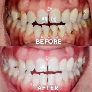 Fluoride-Free Nano Hydroxyapatite Tooth Powder - Image 5
