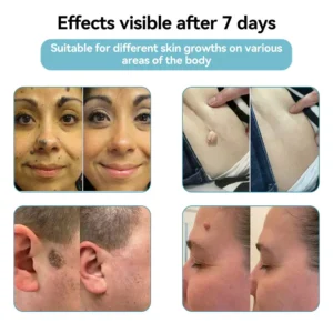 All-in-One CO₂ Laser Eraser Pen | Removes Moles, Warts, Skin Flaws & Pigmentation - Image 7