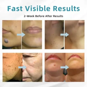 All-in-One CO₂ Laser Eraser Pen | Removes Moles, Warts, Skin Flaws & Pigmentation - Image 8