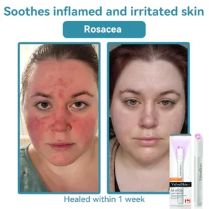 All-in-One CO₂ Laser Eraser Pen | Removes Moles, Warts, Skin Flaws & Pigmentation - Image 9