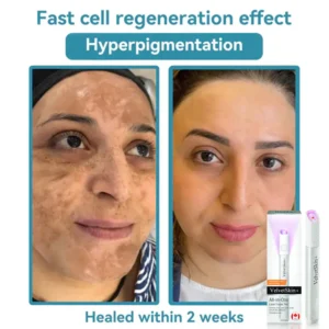 All-in-One CO₂ Laser Eraser Pen | Removes Moles, Warts, Skin Flaws & Pigmentation - Image 10