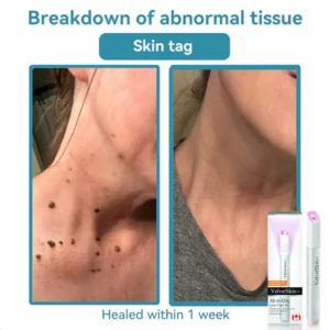 All-in-One CO₂ Laser Eraser Pen | Removes Moles, Warts, Skin Flaws & Pigmentation - Image 11