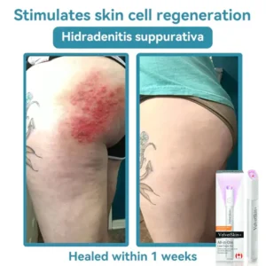 All-in-One CO₂ Laser Eraser Pen | Removes Moles, Warts, Skin Flaws & Pigmentation - Image 12