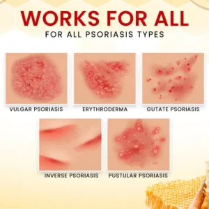 Bee Venom Psoriasis Treatment Cream - Image 4