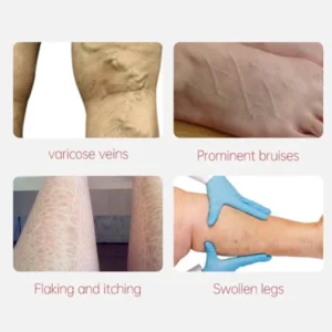 Varicose Veins Relief Cream - Image 6