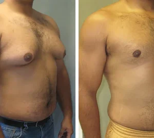 Gynecomastia Cream - Image 4