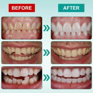 𝗜𝗻𝘀𝘁𝗮𝗻𝘁 𝗦𝘁𝗶𝗰𝗸-𝗼𝗻 𝗗𝗲𝗻𝘁𝗮𝗹 𝗩𝗲𝗻𝗲𝗲𝗿𝘀 (✅Clinically proven, easy-to-use dental veneers trusted by over 8,000 US users for a comfortable, natural smile.) - Image 7
