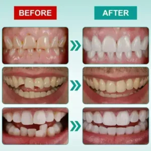 𝗜𝗻𝘀𝘁𝗮𝗻𝘁 𝗦𝘁𝗶𝗰𝗸-𝗼𝗻 𝗗𝗲𝗻𝘁𝗮𝗹 𝗩𝗲𝗻𝗲𝗲𝗿𝘀 (✅Clinically proven, easy-to-use dental veneers trusted by over 8,000 US users for a comfortable, natural smile.) - Image 8