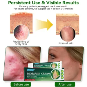 Knotaway Psoriasis Cream - Image 6