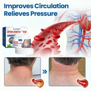 Lipoma Removal Cream - Image 3
