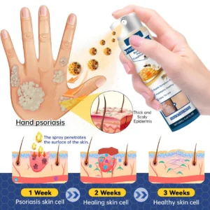 Psoriasis Heal Bee Venom Spray - Image 5