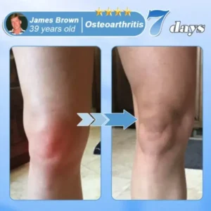 Nano-Microneedle Joint Patch - Image 2
