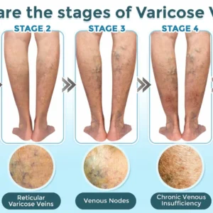 VenaRestore MicroNeedle Vein Repair Patch - Image 3