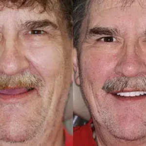 –🦷Advanced Customized Full Denture Set - Image 10