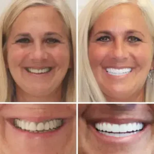 –🦷Advanced Customized Full Denture Set - Image 5