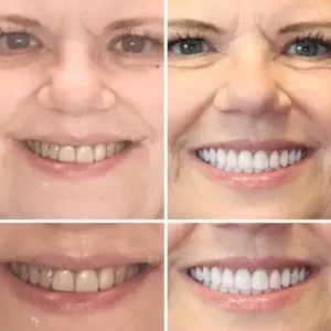–🦷Advanced Customized Full Denture Set - Image 6