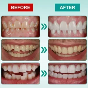 Instant Stick-on Dental Veneers (✅Clinically proven, easy-to-use dental veneers trusted by over 8,000 US users for a comfortable, natural smile.) - Image 4