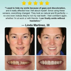 Instant Stick-on Dental Veneers (✅Clinically proven, easy-to-use dental veneers trusted by over 8,000 US users for a comfortable, natural smile.) - Image 3