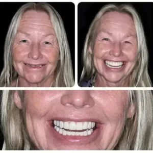【Official Brand -Custom-Fit Functional Dentures — Combination pack - Image 3