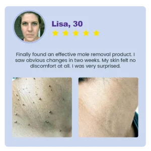 ✅ Official Store: Clarivine Dissolver Mole & Dark Spot Removal Bio-Gel - Image 8