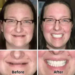 Advanced CustomFit Functional Dentures - Image 4