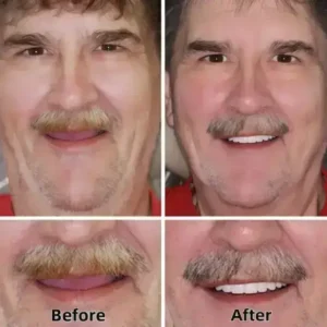 –Advanced Custom-Fit Functional Dentures - Image 6