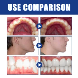 Mandibular Corrector-For a Healthier, More Aligned Smile🦷🔥 - Image 9