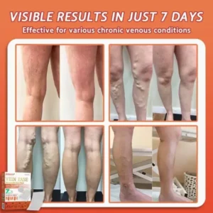 Vein Ease Microneedle Care Patch(For Spider Veins, Varicose Veins, Swelling & Leg Fatigue) - Image 6