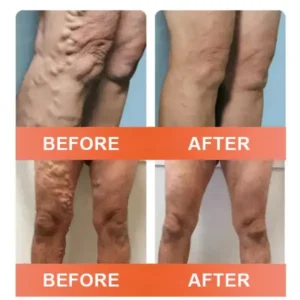 Vein Ease Microneedle Care Patch(For Spider Veins, Varicose Veins, Swelling & Leg Fatigue) - Image 7