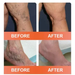 Vein Ease Microneedle Care Patch(For Spider Veins, Varicose Veins, Swelling & Leg Fatigue) - Image 6