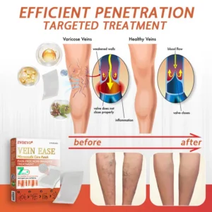 Vein Ease Microneedle Care Patch(For Spider Veins, Varicose Veins, Swelling & Leg Fatigue) - Image 8