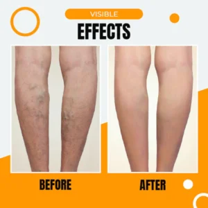 Anti-Varicose Veins Compression Stockings - Image 8