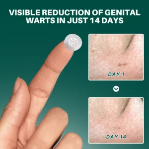 Magnesium MicroPin HPV Genital Wart Removal Patch - Image 4