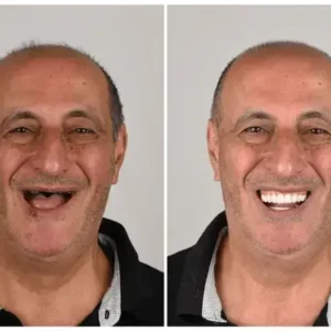 🦷 Custom-Fit Functional Dentures 😁 Smile with Confidence - Image 2