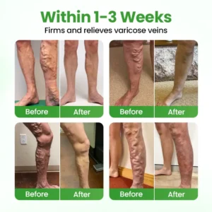 VeinHeal Microneedle Patch - Image 2