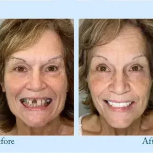 – Premium-Zahnprothese - Image 7