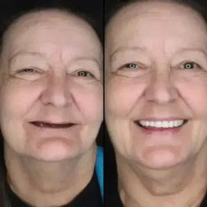 【Official Brand -Custom-Fit Functional Dentures — Combination pack - Image 2