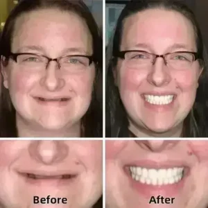–Advanced Custom-Fit Functional Dentures - Image 4